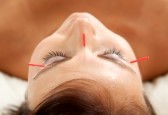 Anti aging acupuncture treatment on young attractive female patient